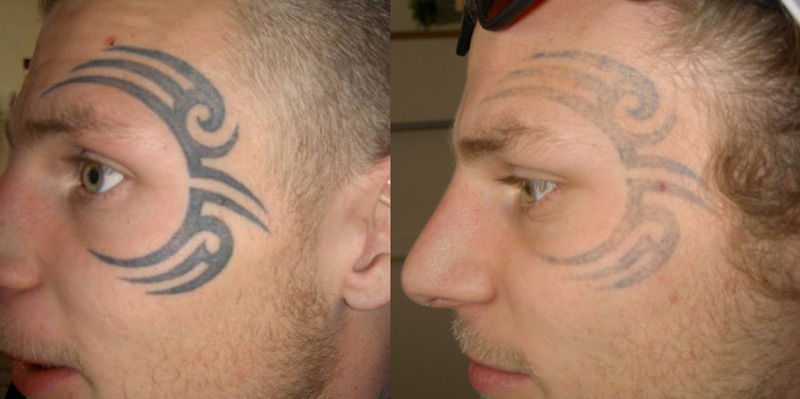 tatueringsborttagning-ansikte.jpg