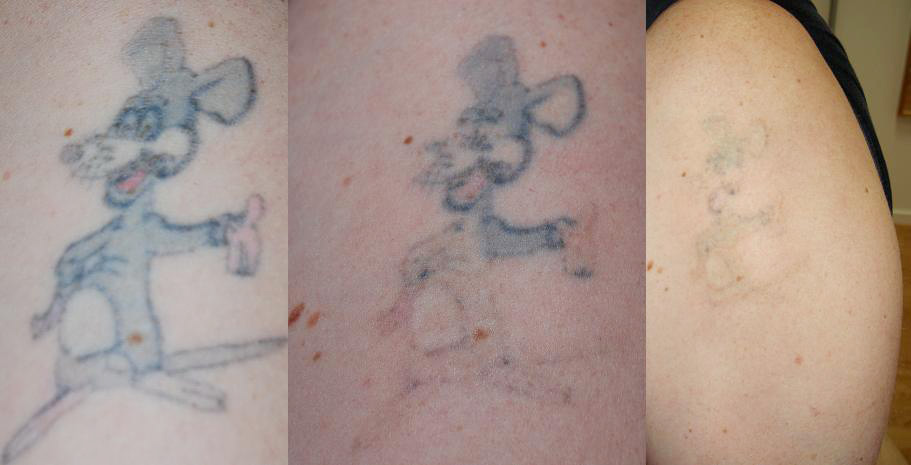 tatueringsborttagning-axel.jpg