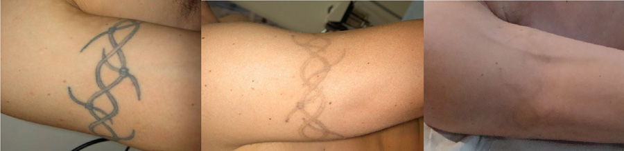 tatueringsborttagning-overarm.jpg