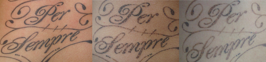 tatueringsborttagning-per-sempre.jpg