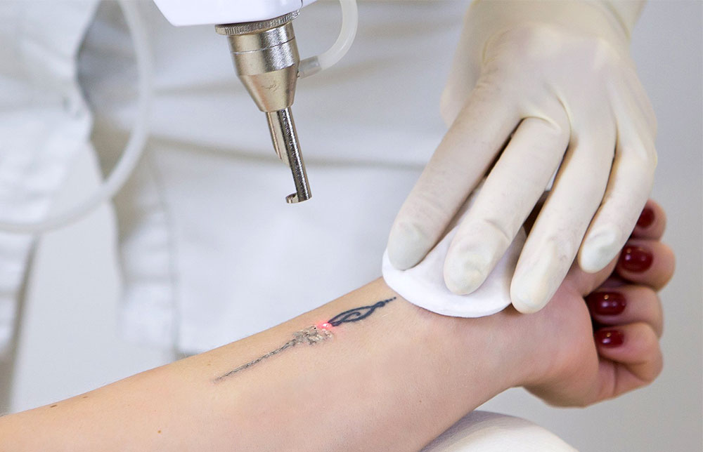 Ta effektivt bort tatueringar med laser