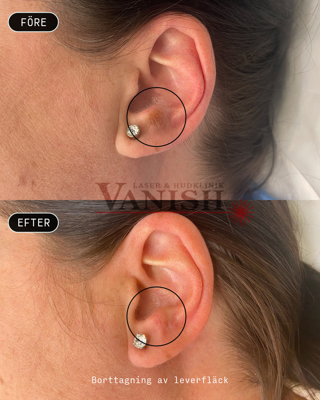 Laserbehandling leverfläck öra