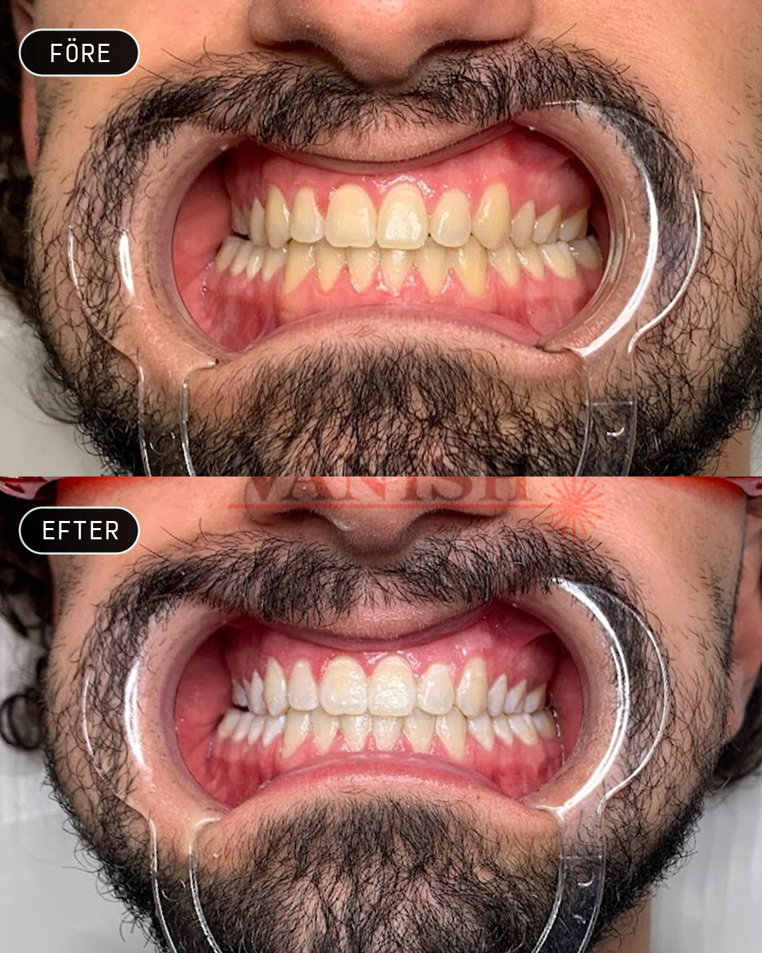 Vitare tänder med skonsam blekning med plasmaljus
