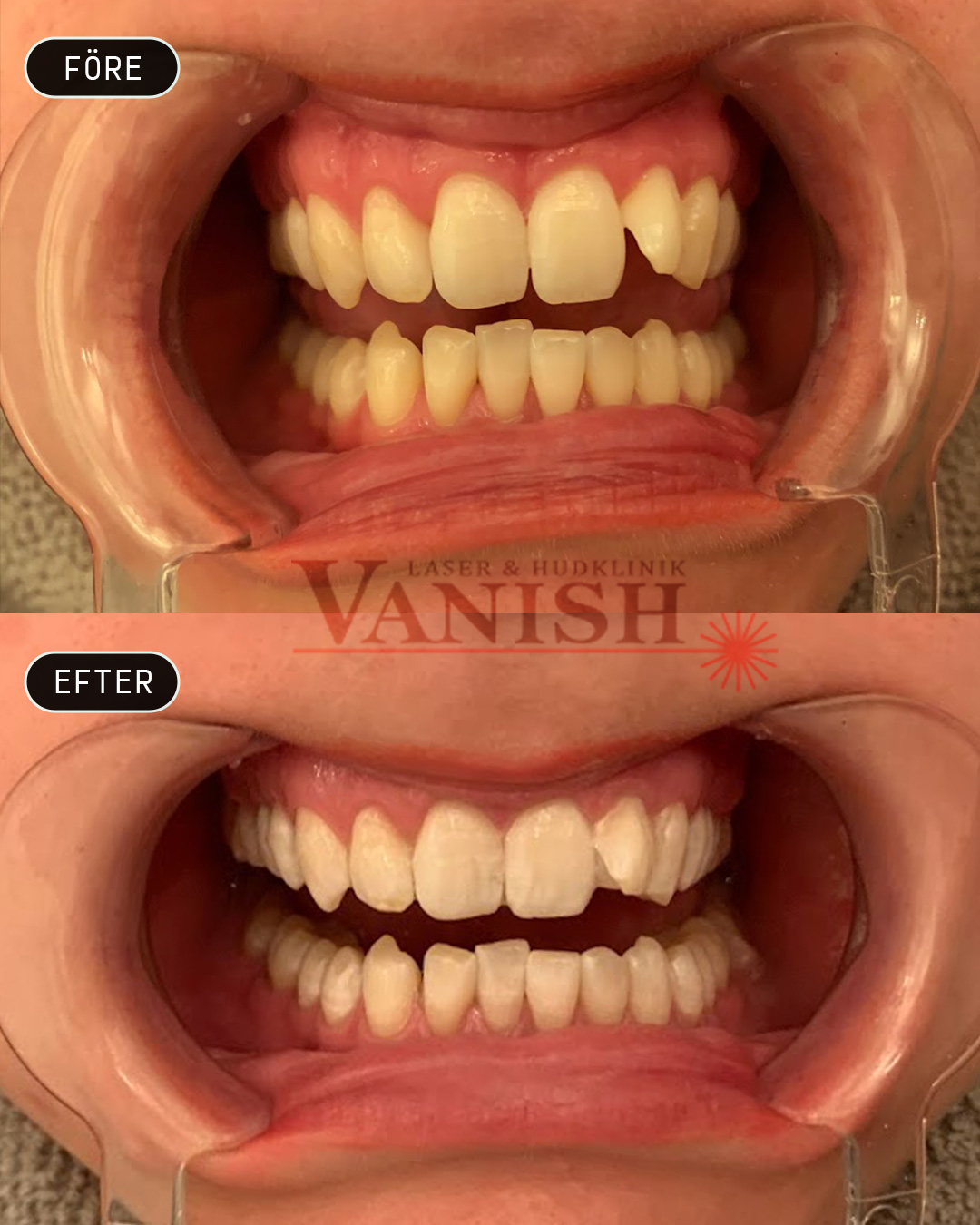 Få vitare tänder med plasmaljus