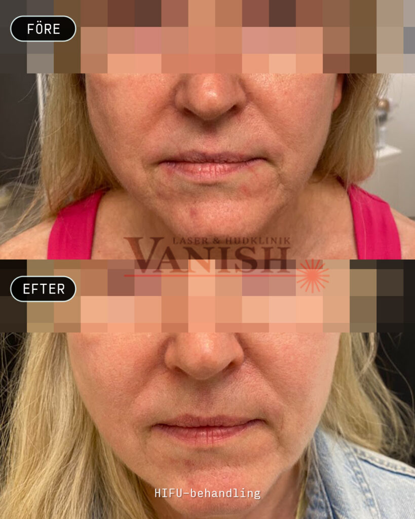 HIFU-behandling för fastare hud i ansiktet