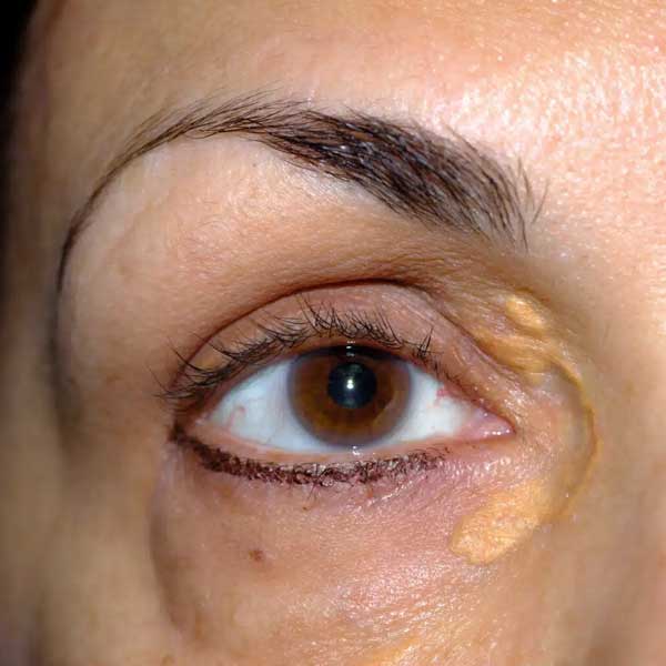 Behandling mot Xantelasma