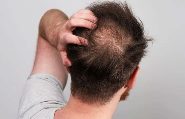 Exosombehandling för manligt håravfall