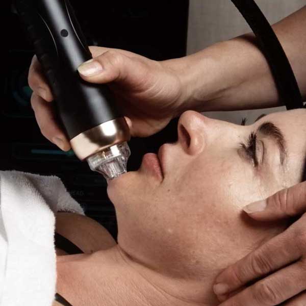 RF Microneedling