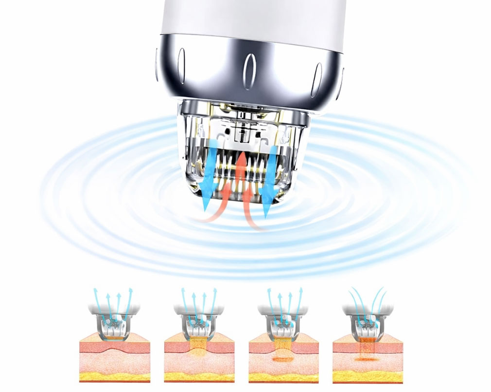 Microneedling med radiofrekvens-energi