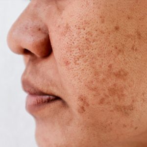 melasma Melasma